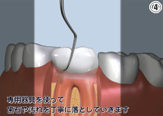 歯石